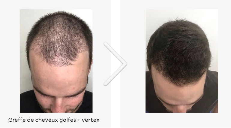 Greffe de cheveux golfes + vertex