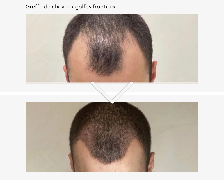 Greffe de cheveux golfes frontaux