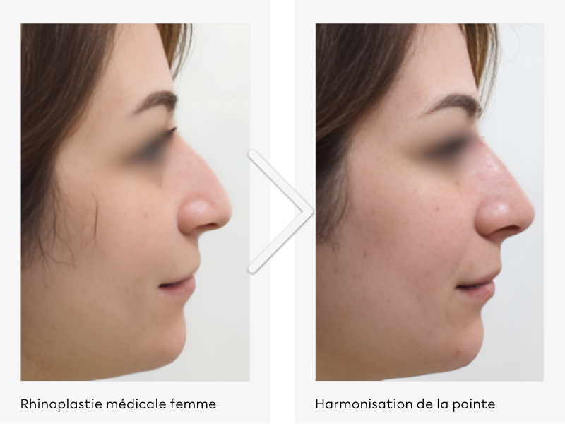 Rhinoplastie médicale Harmonisation de la pointe du nez