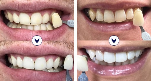 Protège-dents pour le grincement des dents la nuit - Kit de redressement  des dents, appareil dentaire amélioré en 3 étapes pour redresser les dents,  empêcher le grincement des dents : : Hygiène
