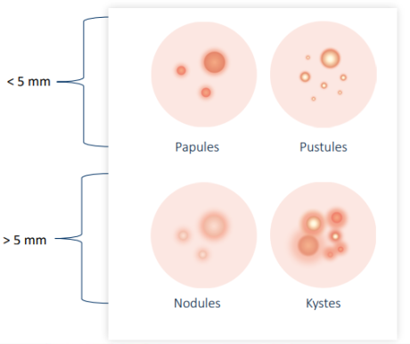 acne-active-inflammatoire-papules-pustules-nodules-kystes
