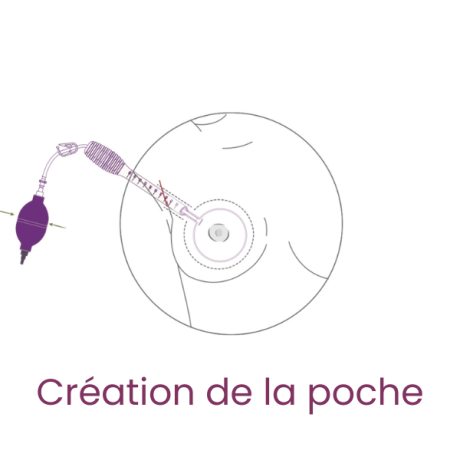 MIA_etape_3-creation-poche