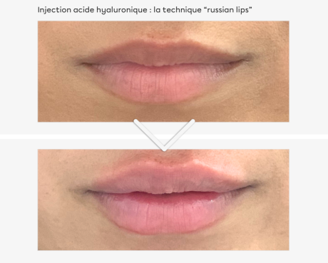 Injections lèvres Russian Lips