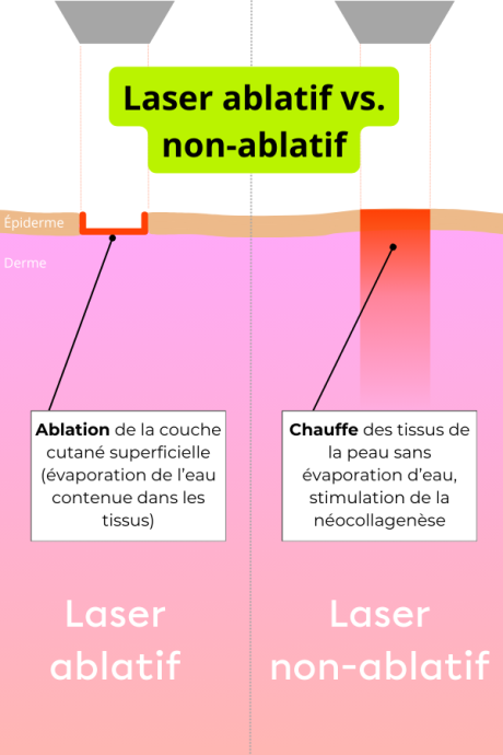 Lasers-esthetiques-difference-ablatif-vs-non-ablatif