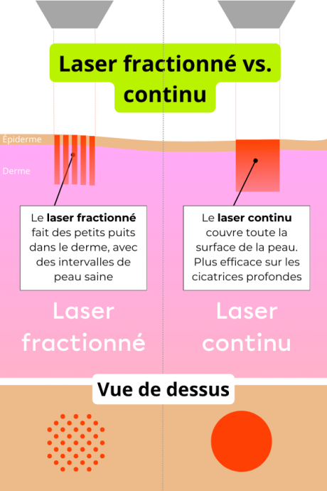 Lasers-esthetiques-difference-fractionné-vs-non-fractionné