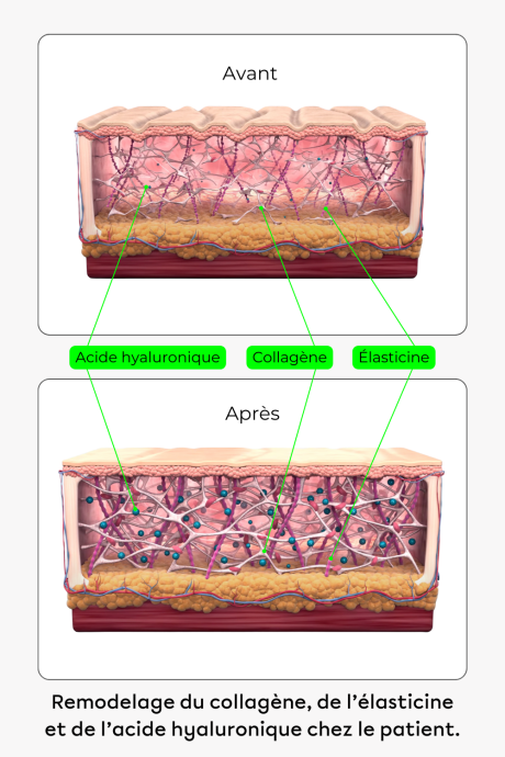 SOFWAVE production elasticine collagene et acide hyaluronique