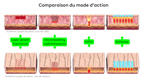 ofwave comparaison MOA coupe de peau