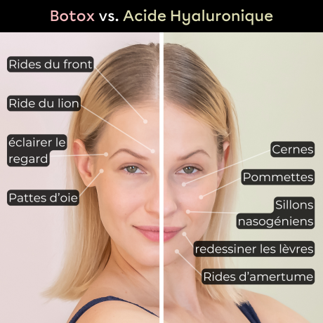 Botox vs. Acide Hyaluronique